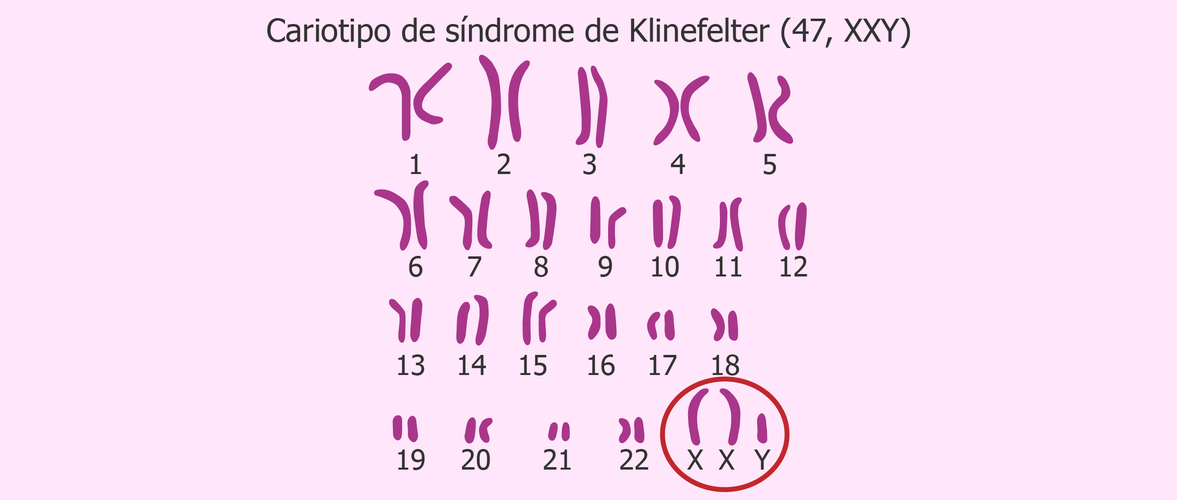 Síndrome de Klinefelter